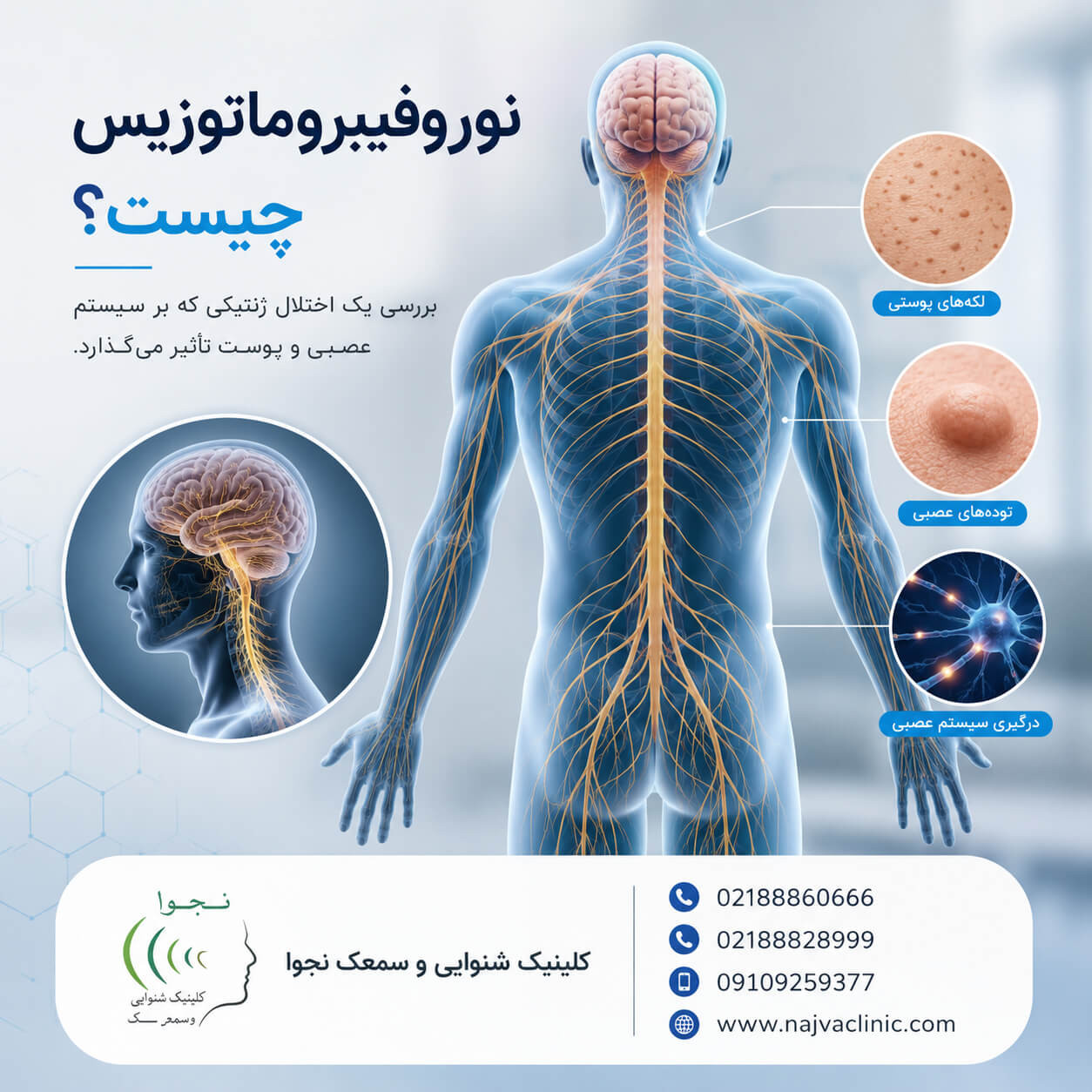 نوروفیبروماتوزیس و علائم آن